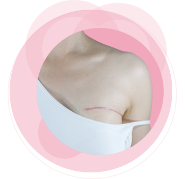 Teaser Brustoperation rosa