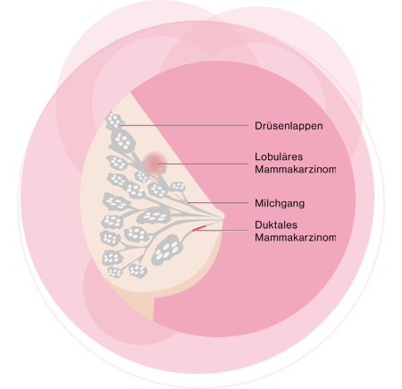 Grafik Duktus und Lobuli Brustkrebs verstehen rosa