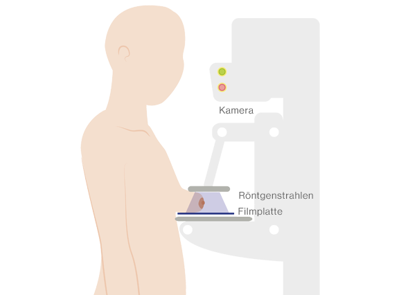Grafik Mammografie Diagnose Brustkrebs