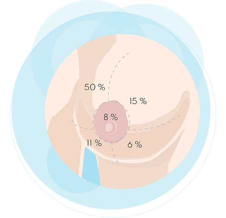 Teaser Die Lage des Brusttumors Kreise blau